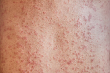 rash on the body